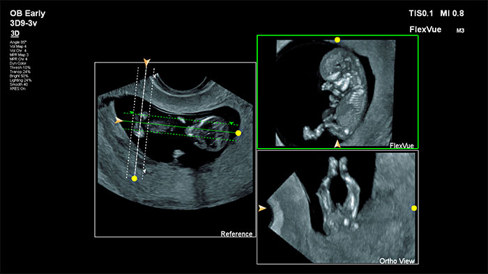 FlexVue and Orthogonal view clinical applications youtube video thumbnail