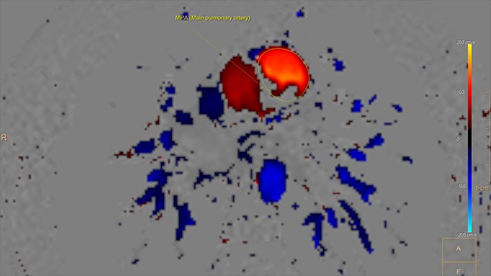 magnetic resonance qflow