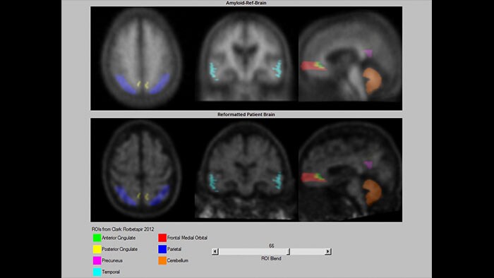 neuroq amyloid thumbnail