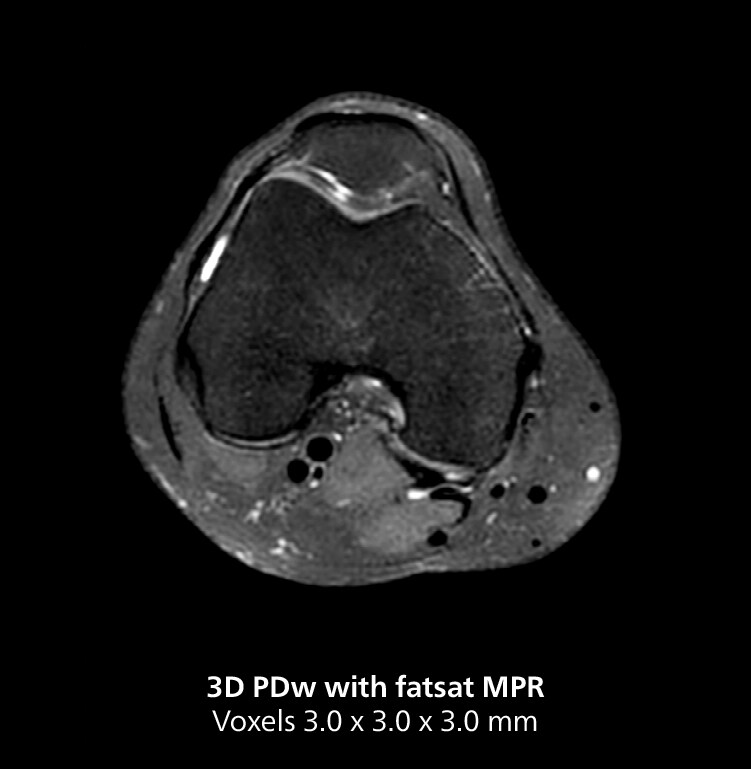Knee mri three