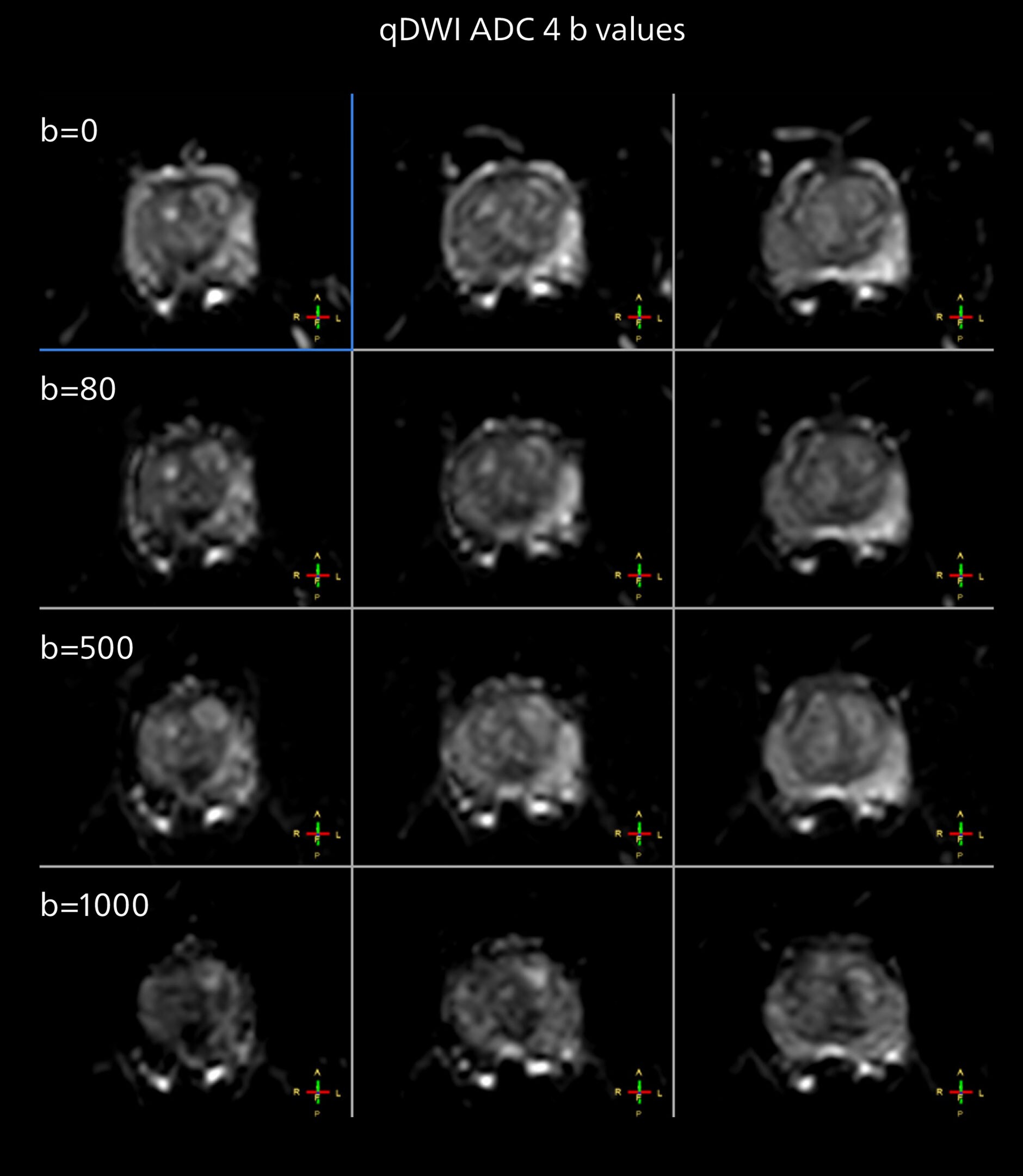 Prostate mri one