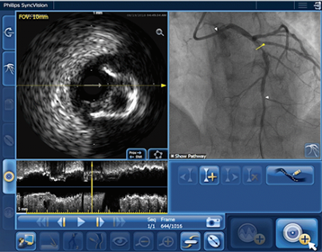 IVUS Co-registration