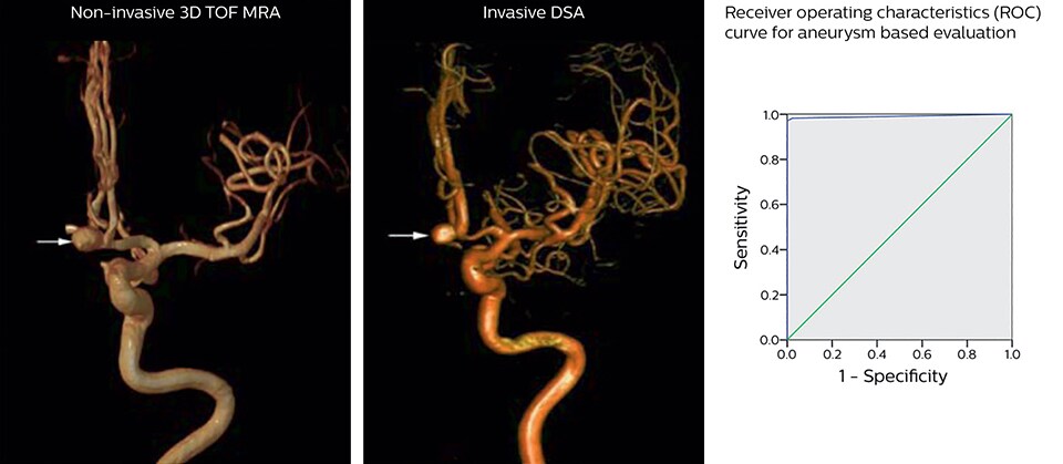 small aneurysm 3d tof mra and dsa