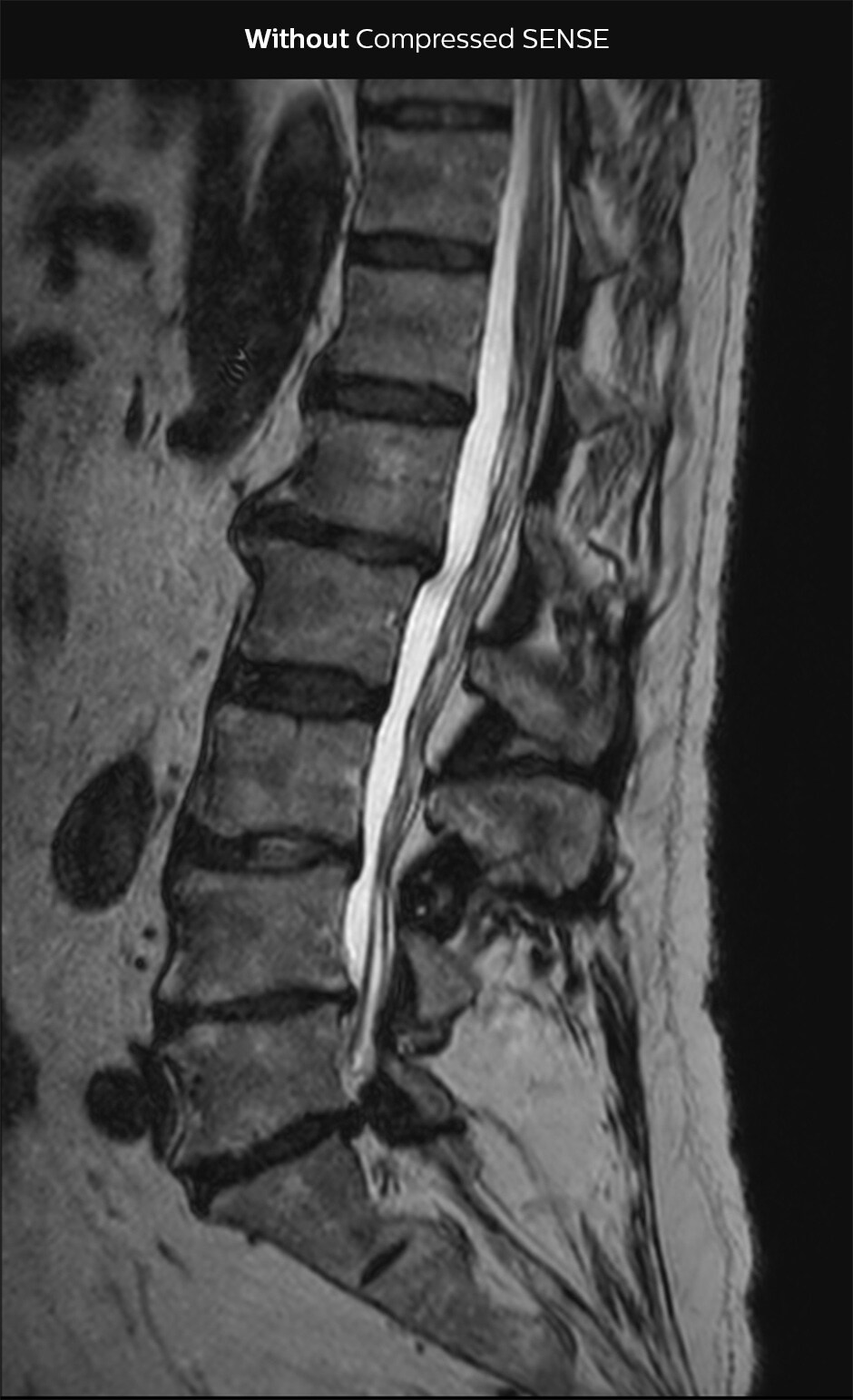 3D T2 SpineVIEW lumbar spine WITHOUT Compressed SENSE