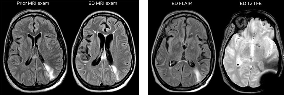 prior mri and mri in ed meningeal carcinomatosis