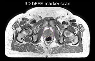 Turku MRI-marker scan therapy case 3
