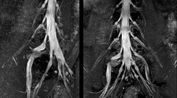 MRI of right L5 radiculopathy