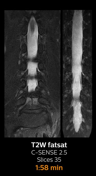 T2W fatsat magnetic resonance imaging