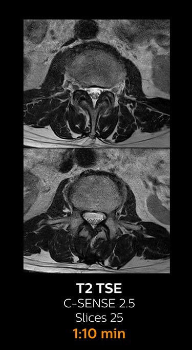 T2 TSE magnetic resonance imaging