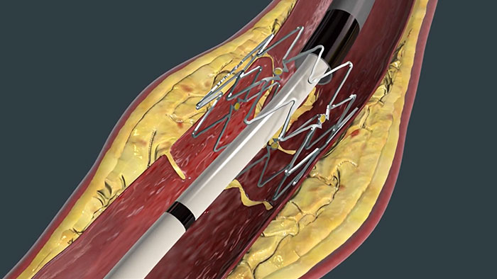TACK Endovascular System youtube video thumbnail