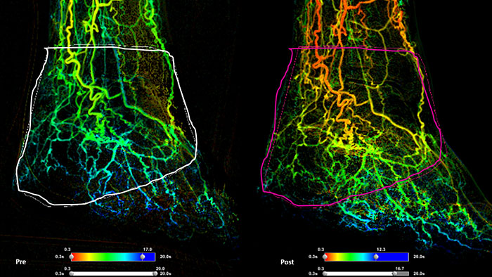SmartPerfusion thumbnail