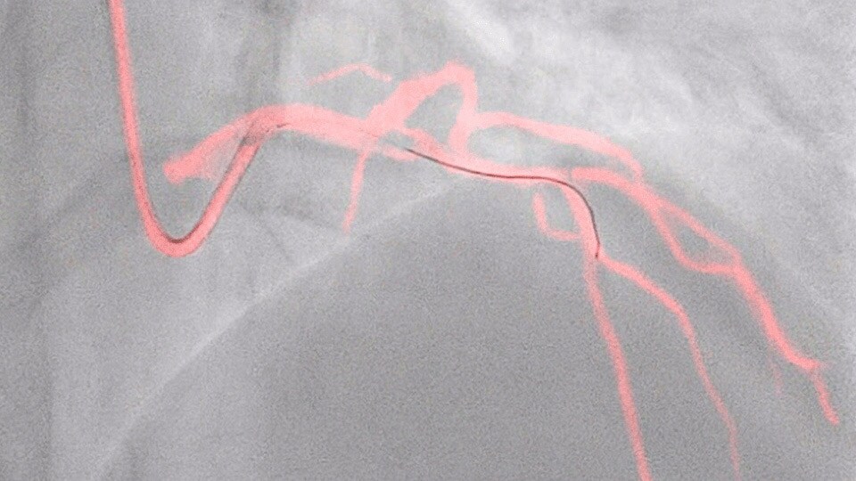 Dynamic Coronary Roadmap visuals