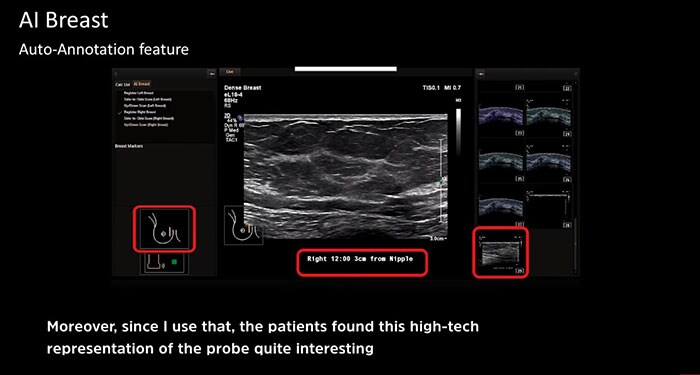 Breast Ultrasound Breast Assessment Solutions Philips Healthcare