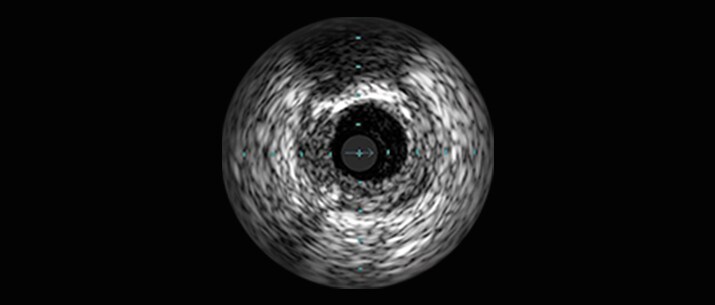 Saphenous vein graft and thrombus lesions masthead