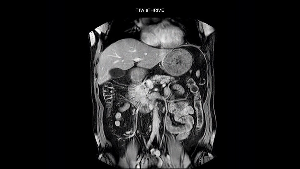 Bremen Clinical case Pancreas tumor